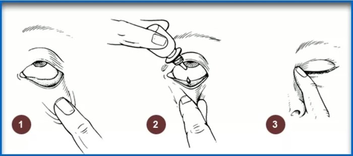 Как закапывать глаза. Закапывание капель в глаза алгоритм. Как закапывать глазные капли в конъюнктивальный мешок самому себе. Схема закапывания глазных капель. Как правильно закапать глазные капли схема.